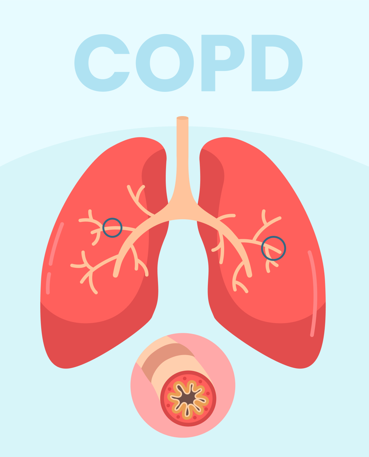Chronic Obstructive Pulmonary Disease Overview