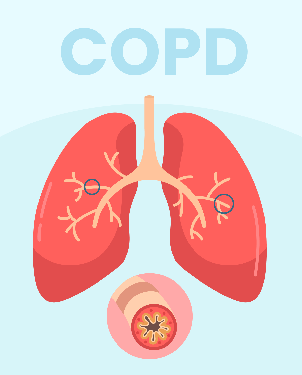 Chronic Obstructive Pulmonary Disease Copd