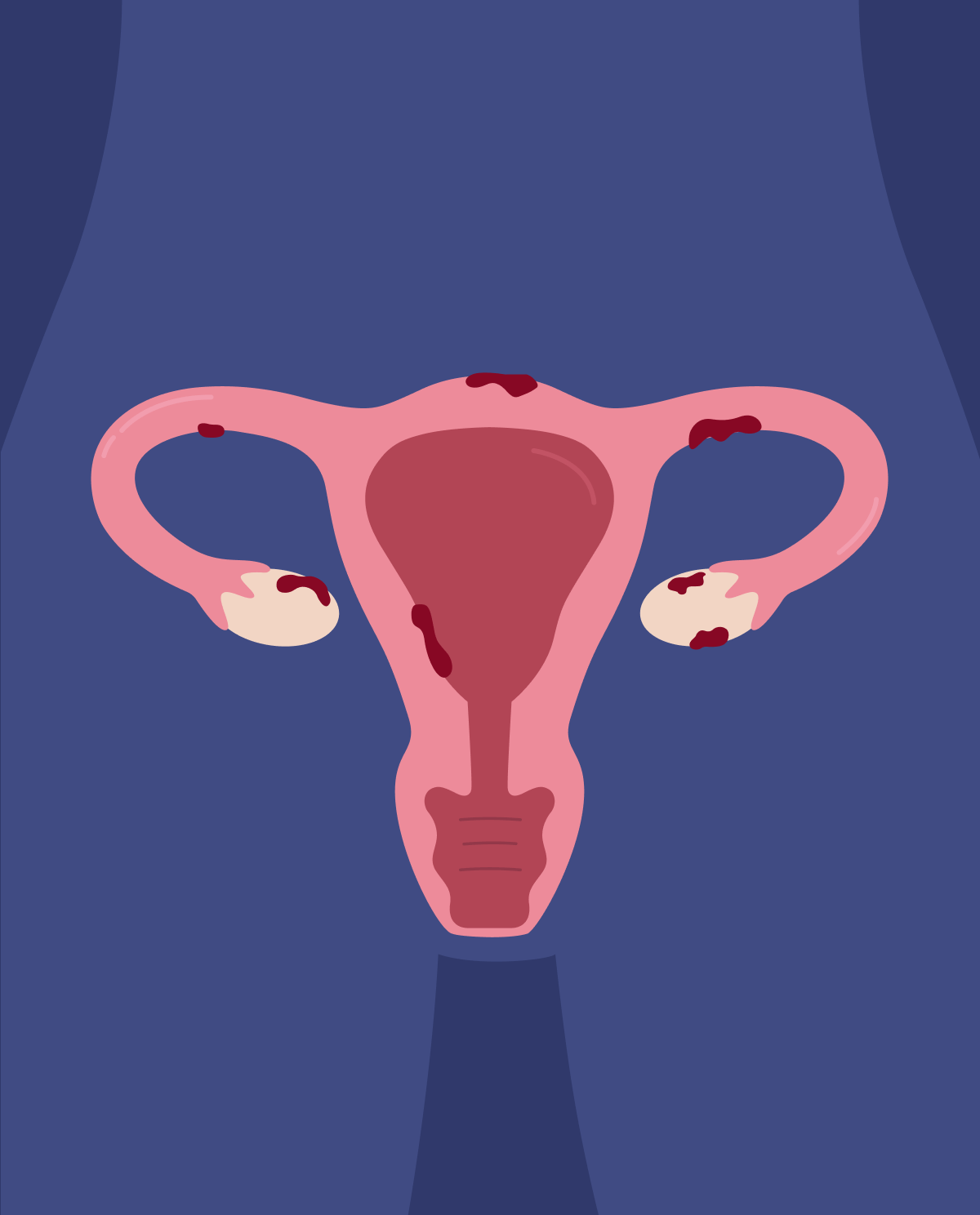 Endometriosis: causes, symptoms and treatment