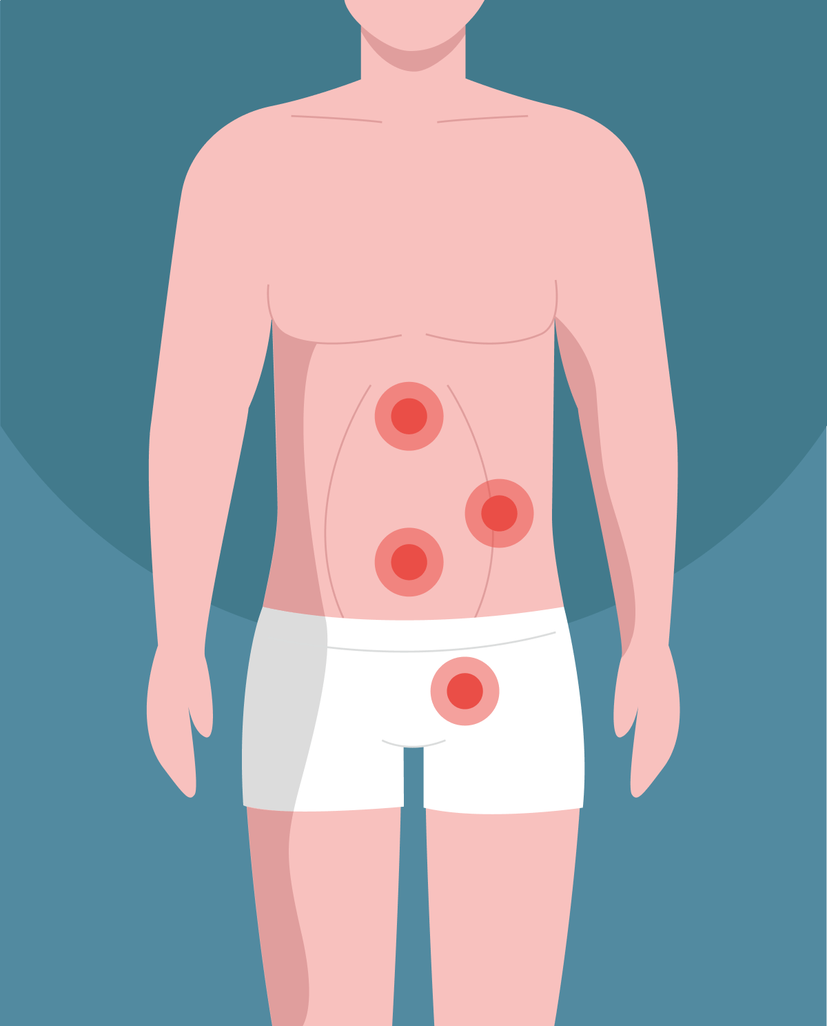 Hernia Overview: causes, types, and treatment