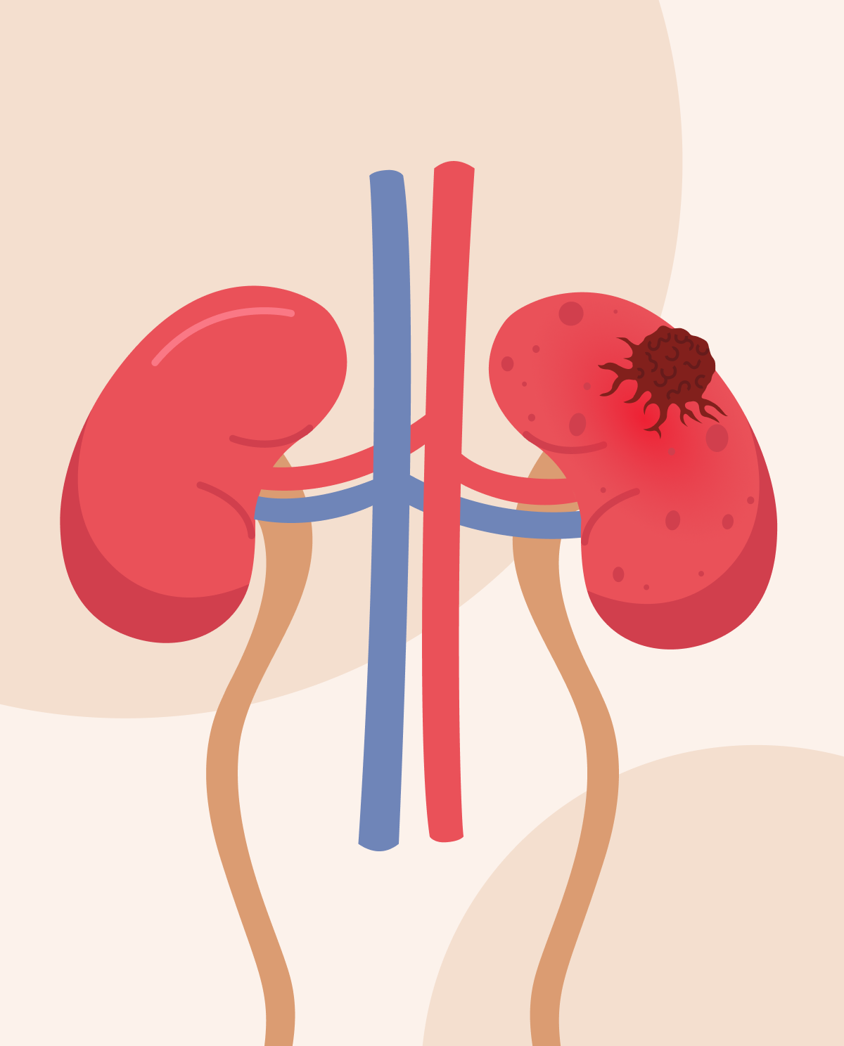 Kidney Cancer: A Guide to Types & Treatment
