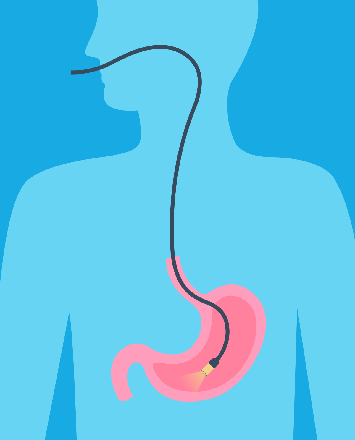 Gastroskopia - czym jest i jak się do niej przygotować?