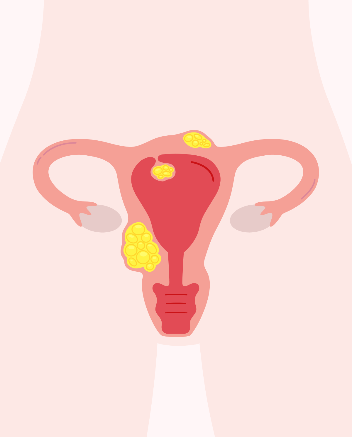 Overview of uterine fibroids (leiomyomas)